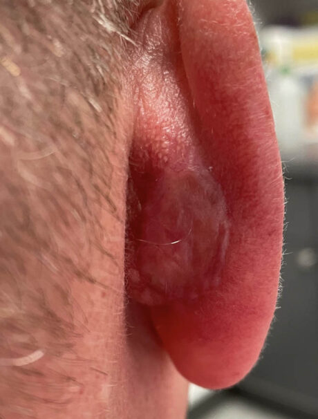 Skin Cancer Reconstruction case #18074
