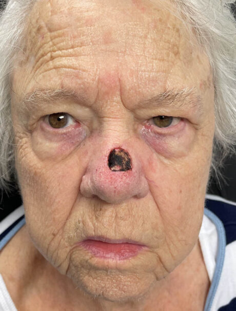 Skin Cancer Reconstruction case #18048