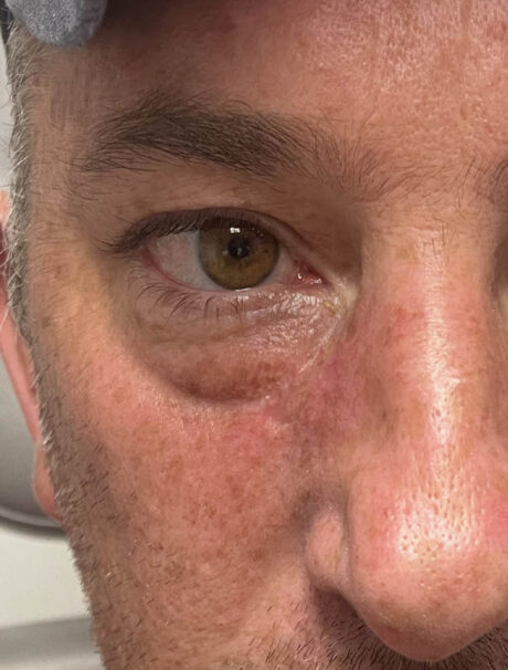 Skin Cancer Reconstruction case #18045