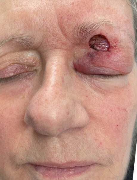 Skin Cancer Reconstruction case #17969