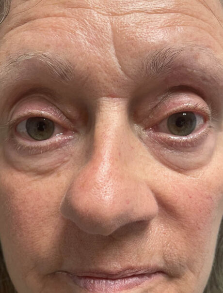 Skin Cancer Reconstruction case #17969