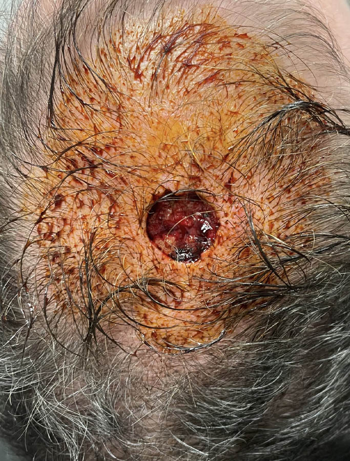 Skin Cancer Reconstruction case #17963