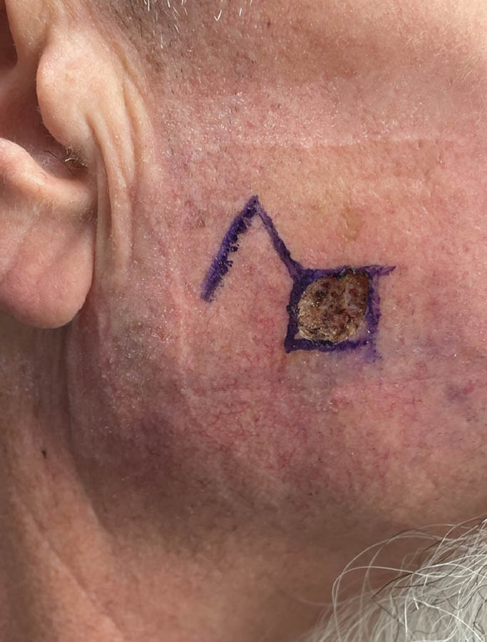 Skin Cancer Reconstruction case #17960