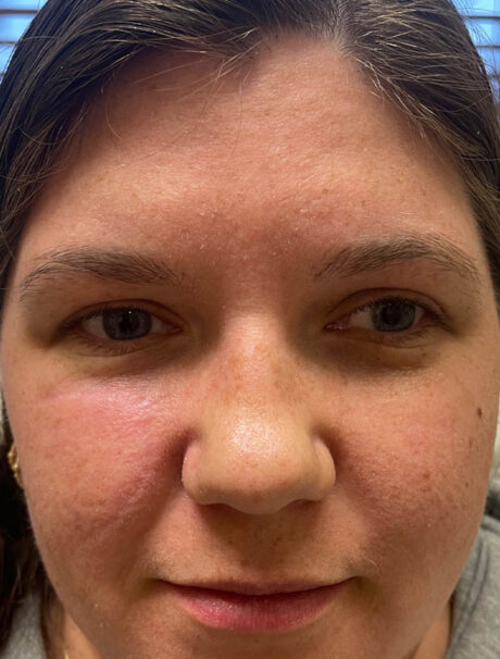 Skin Cancer Reconstruction case #17941