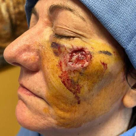 Skin Cancer Reconstruction case #18594