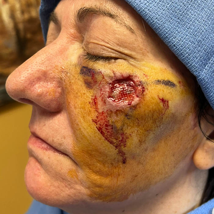 Skin Cancer Reconstruction case #18594