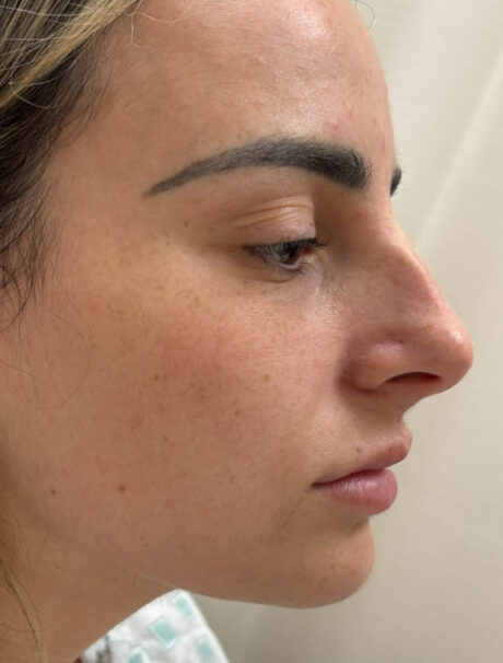 Rhinoplasty case #18648