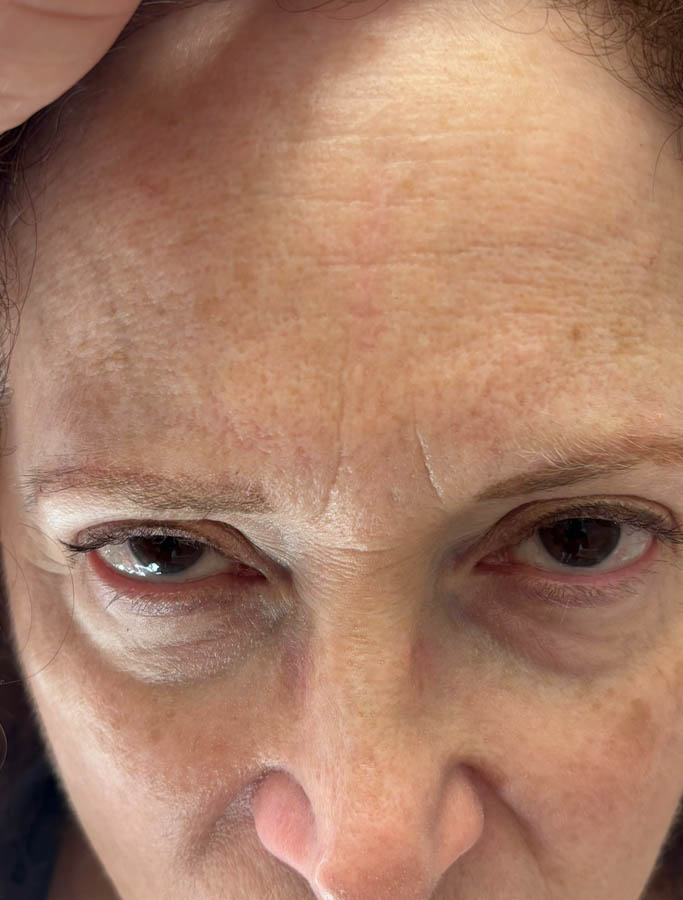 Facial Trauma case #18570