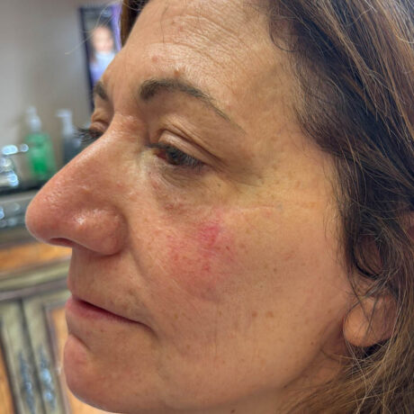 Skin Cancer Reconstruction case #18594