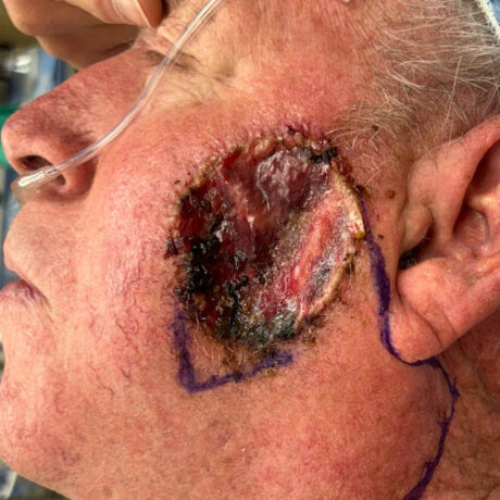 Skin Cancer Reconstruction case #18597