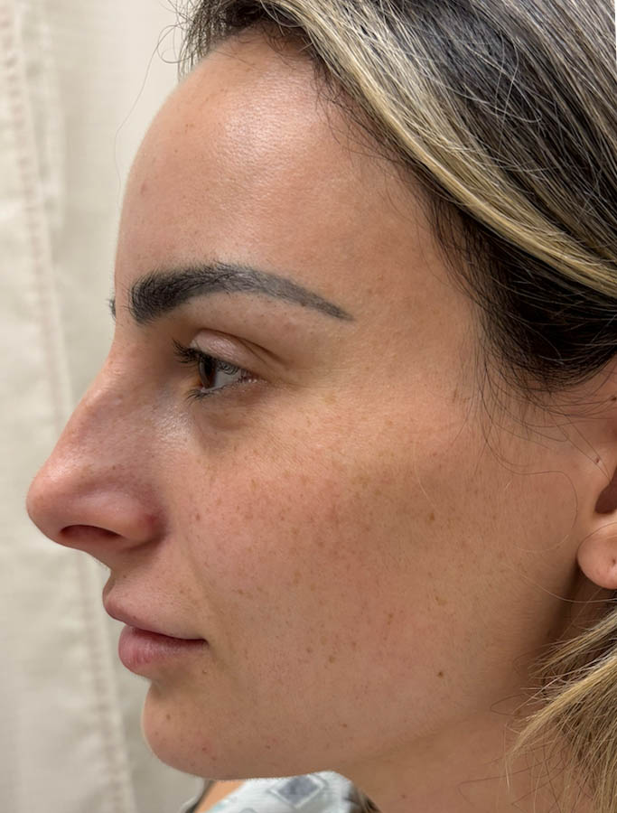 Rhinoplasty case #18648