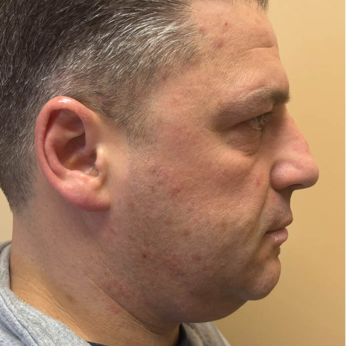 Facial Contouring/ Buccal Fat Removal case #18559