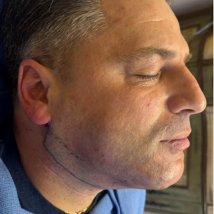 Facial Contouring/ Buccal Fat Removal case #18559