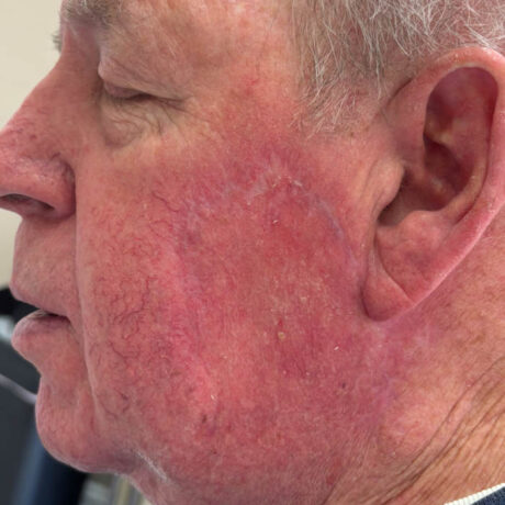 Skin Cancer Reconstruction case #18597