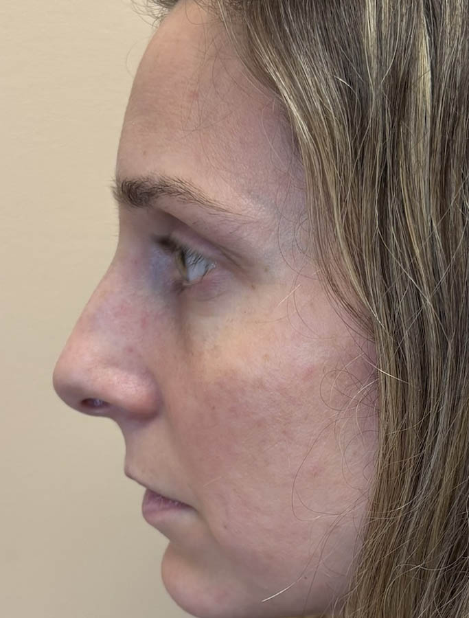Rhinoplasty case #18655