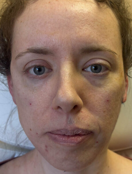 Facelift/Necklift case #18613