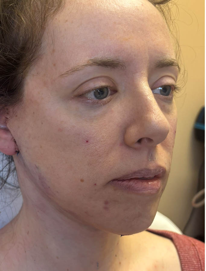 Facelift/Necklift case #18613