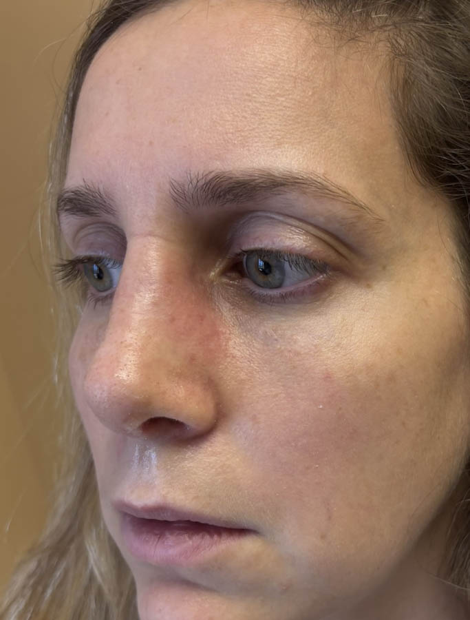 Rhinoplasty case #18655