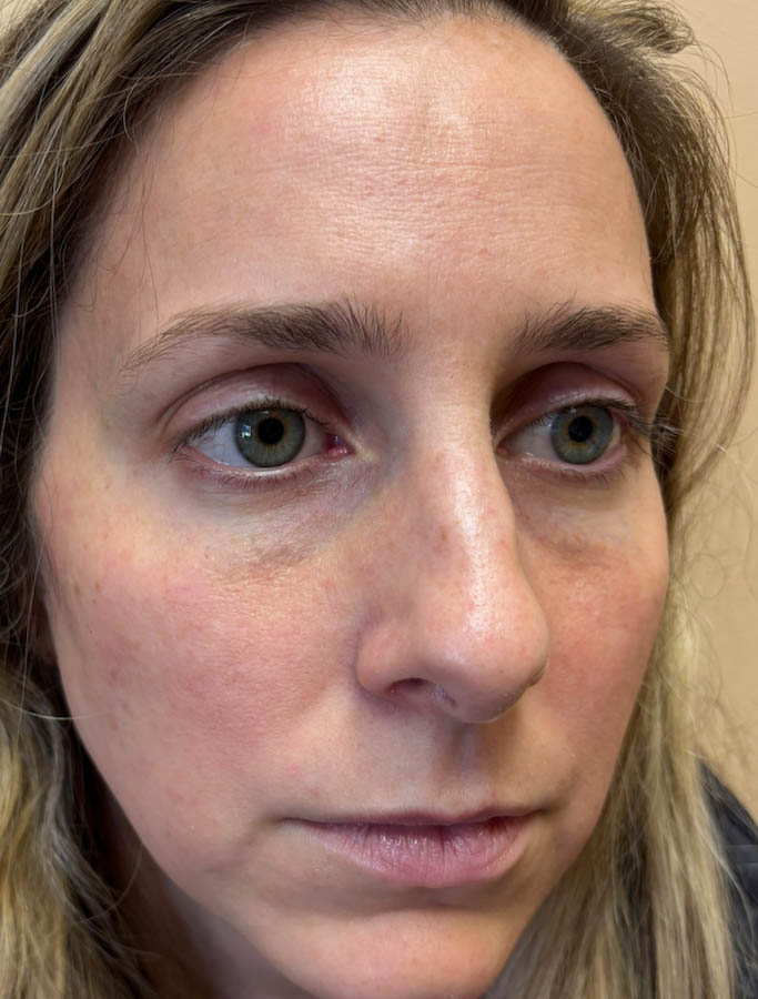 Rhinoplasty case #18655