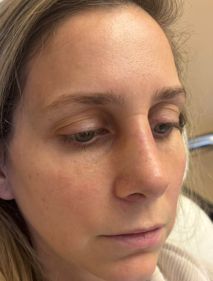 Rhinoplasty case #18655