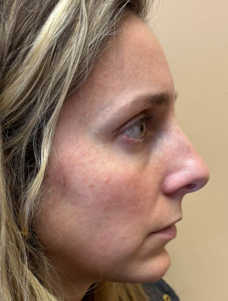 Rhinoplasty case #18655