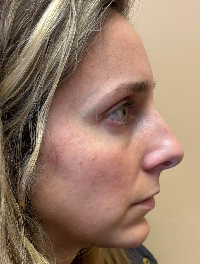 Rhinoplasty case #18655