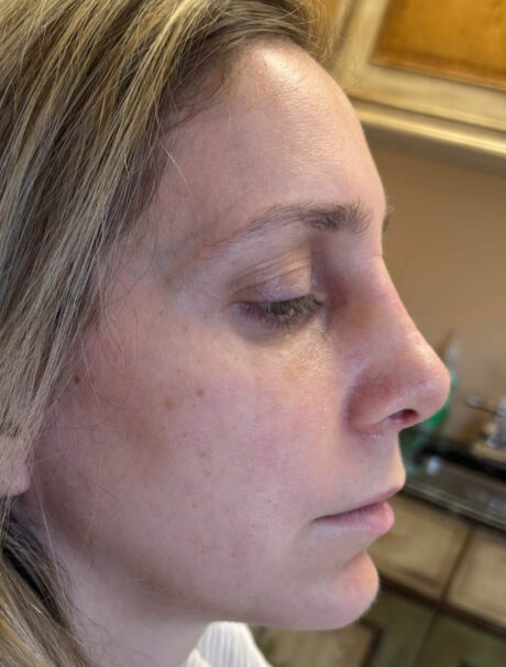 Rhinoplasty case #18655