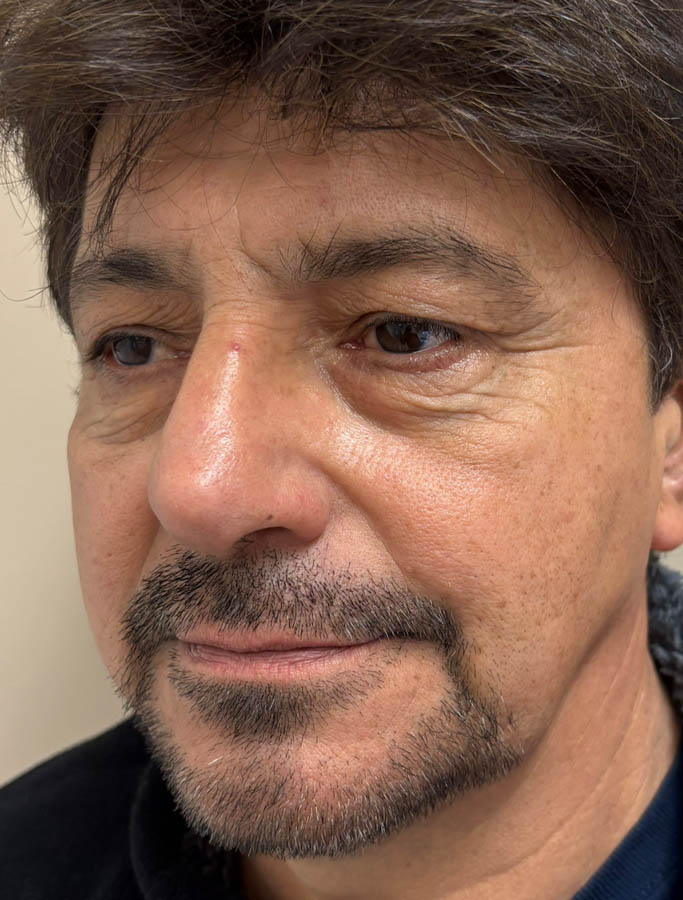 Blepharoplasty case #18625