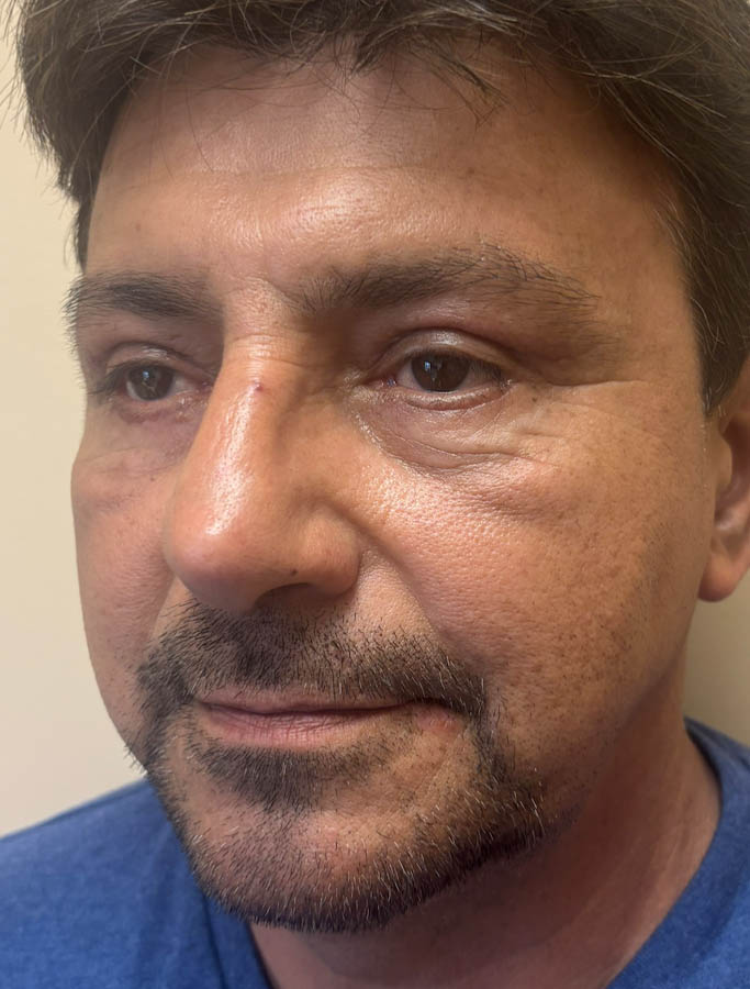 Blepharoplasty case #18625