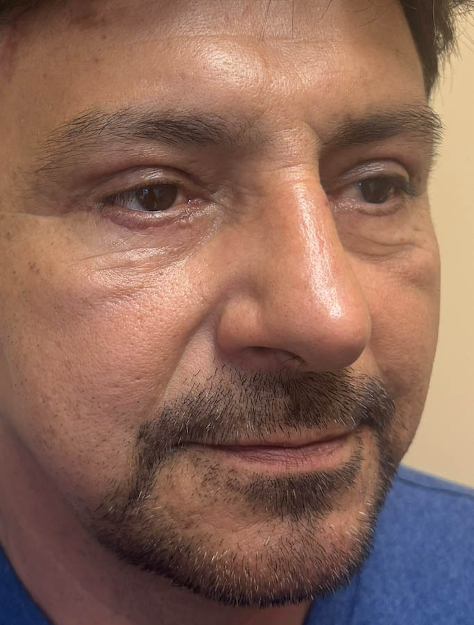 Blepharoplasty case #18625