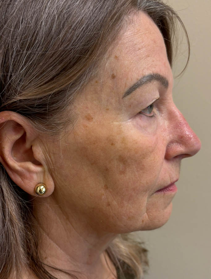 Facelift/Necklift case #18636
