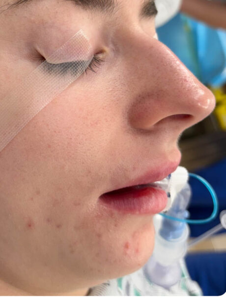 Rhinoplasty case #18675