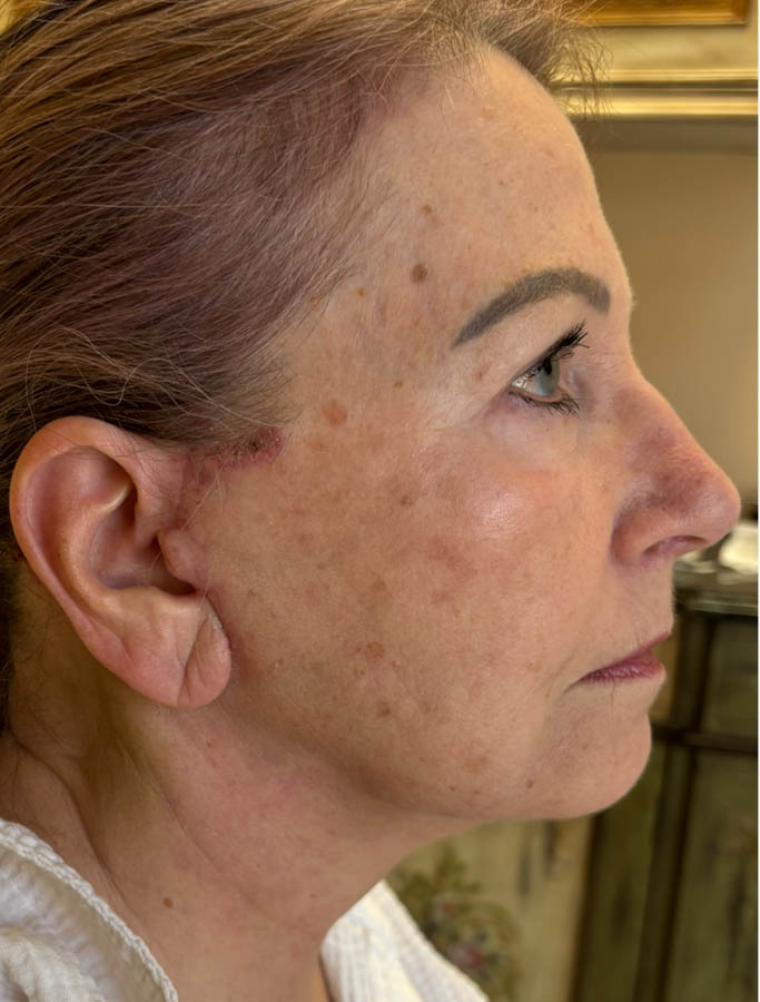 Facelift/Necklift case #18636