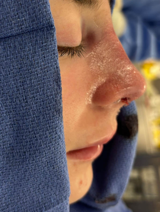 Rhinoplasty case #18675