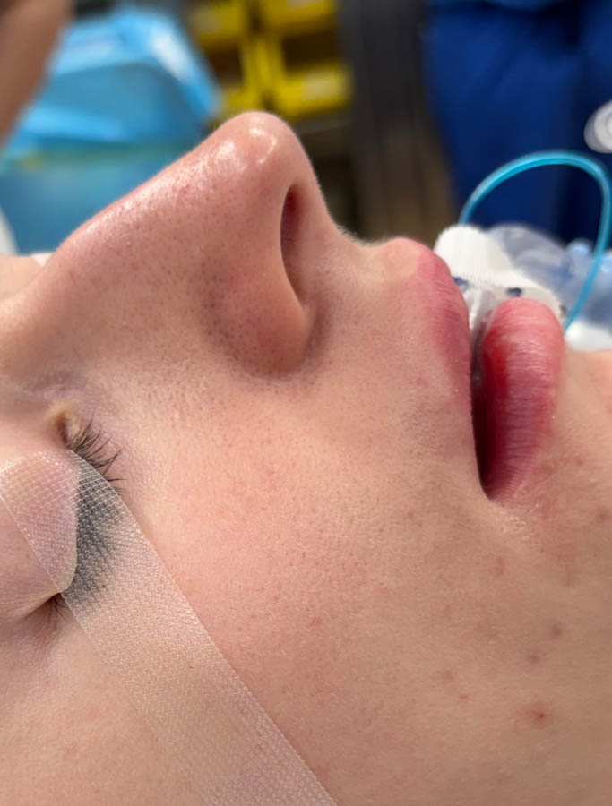 Rhinoplasty case #18675