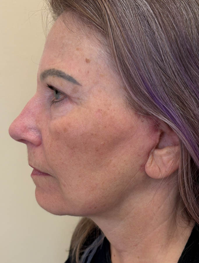 Facelift/Necklift case #18636