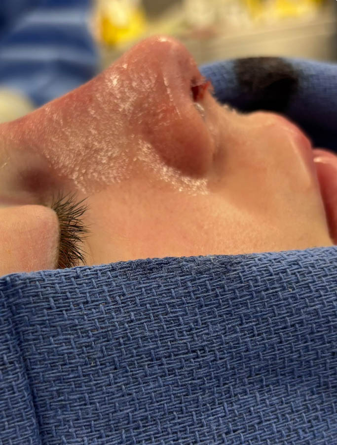 Rhinoplasty case #18675