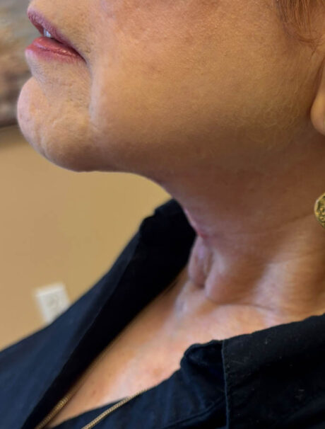 Facelift/Necklift case #18643