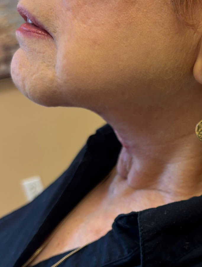 Facelift/Necklift case #18643