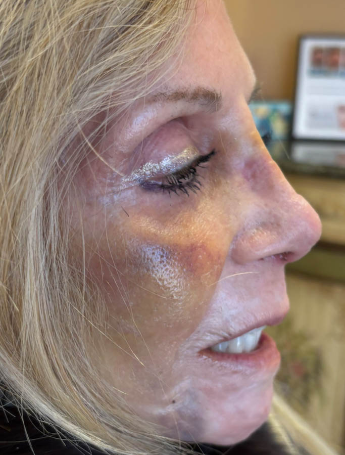 Rhinoplasty case #18682