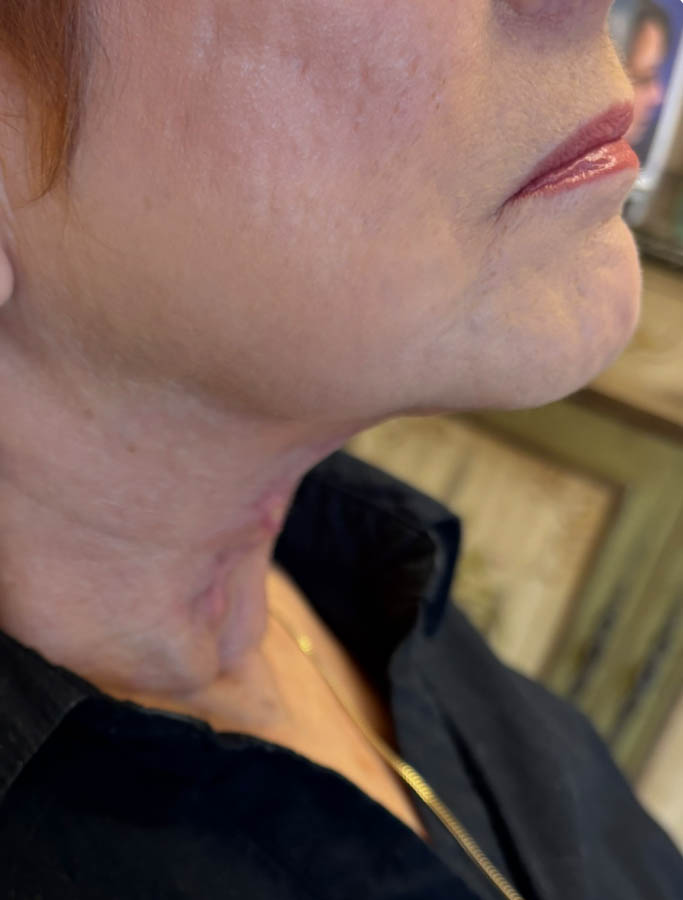 Facelift/Necklift case #18643