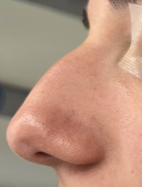 Rhinoplasty case #18687