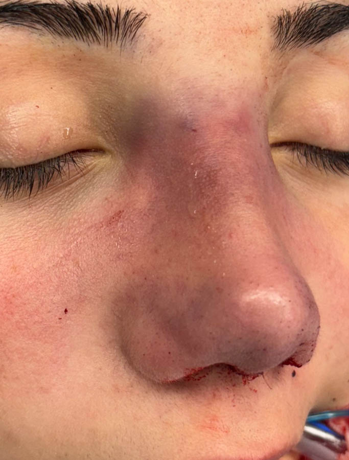 Rhinoplasty case #18687