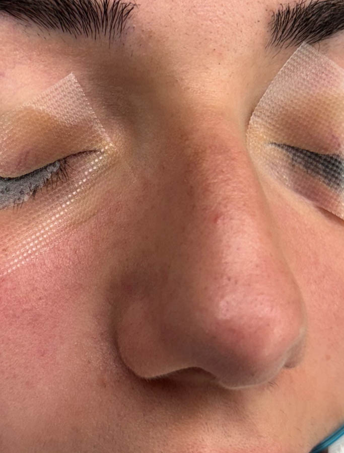 Rhinoplasty case #18687