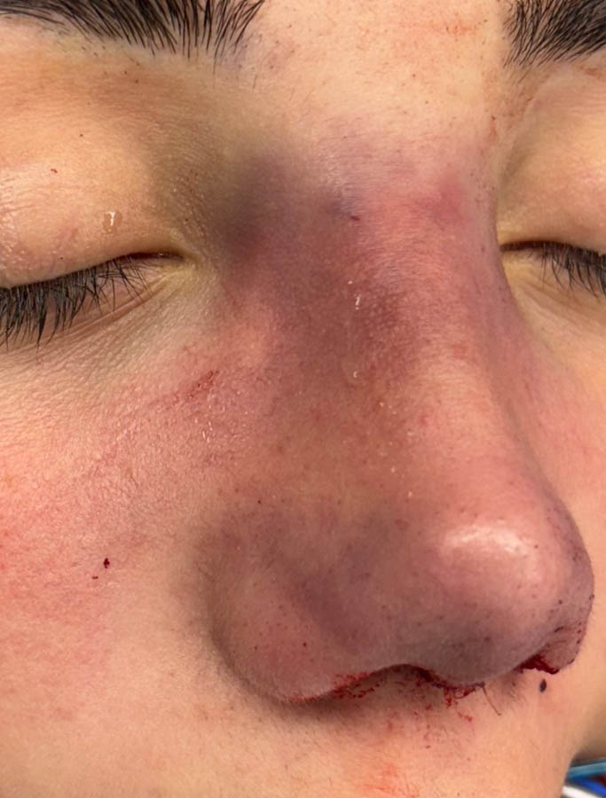 Rhinoplasty case #18687