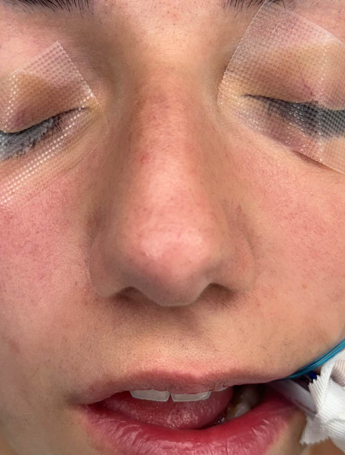 Rhinoplasty case #18687