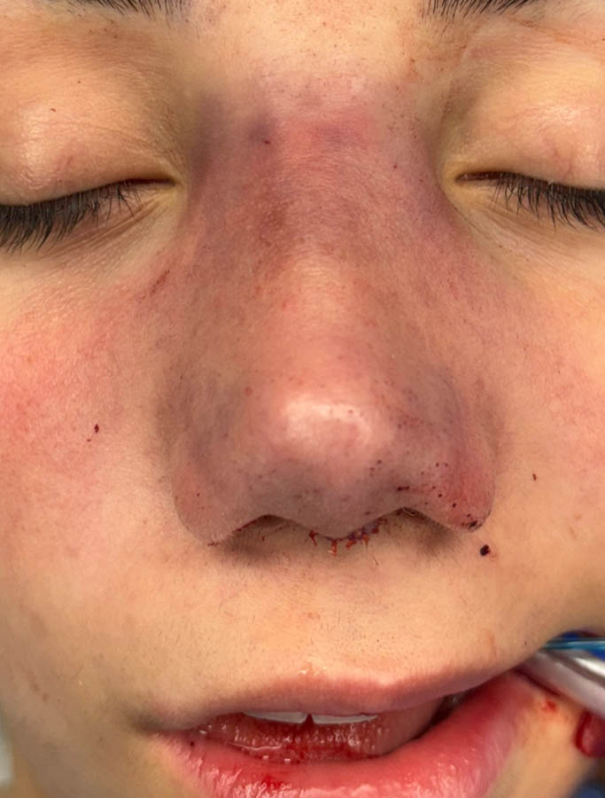 Rhinoplasty case #18687