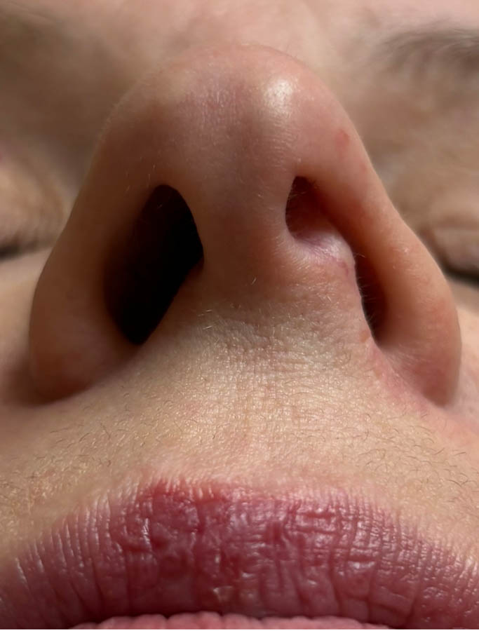 Rhinoplasty case #18700