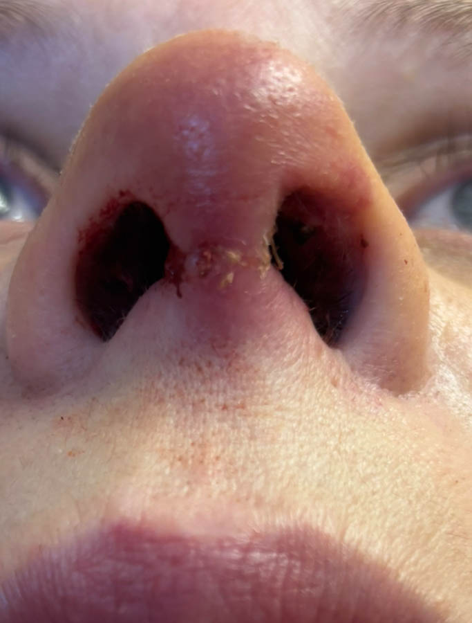Rhinoplasty case #18700