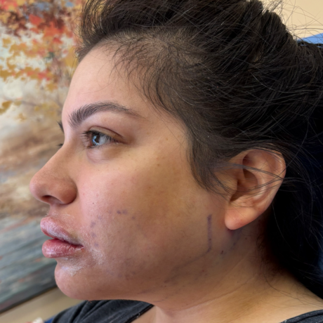 Facial Contouring/ Buccal Fat Removal case #18564